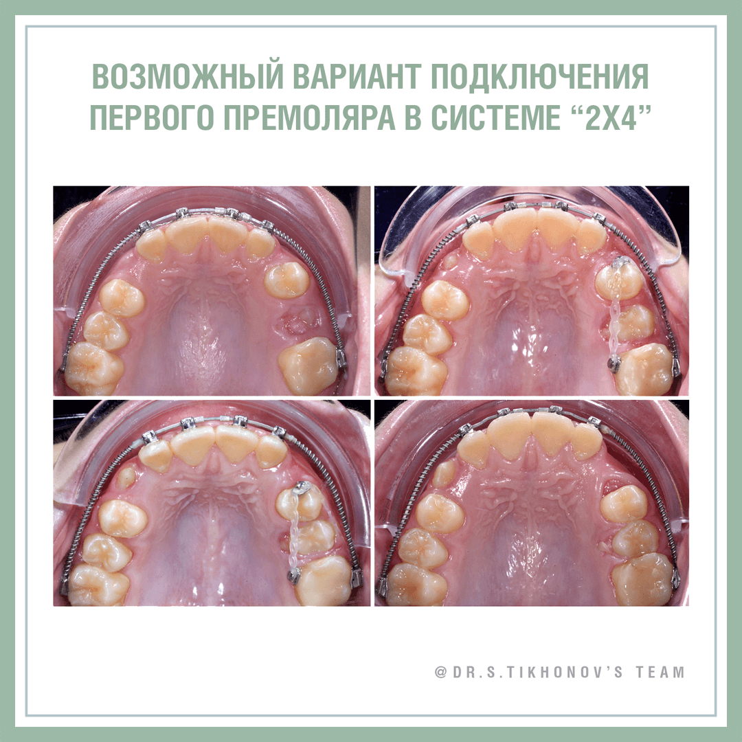 Непослушная 4-ка, или нюансы лечение частичной брекет-системой. - интересно  об ортодонтии, имплантации и протезировании зубов